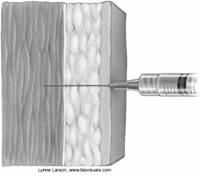 intramuscular injection site
